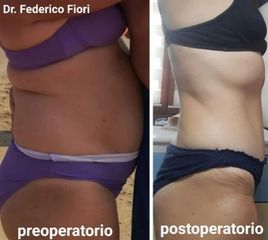 Addominoplastica - Dott. Fiori Federico
