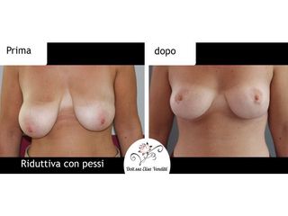 Mastoplastica riduttiva prima e dopo