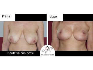 Mastoplastica riduttiva prima e dopo