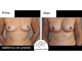 Mastoplastica additiva prima e dopo