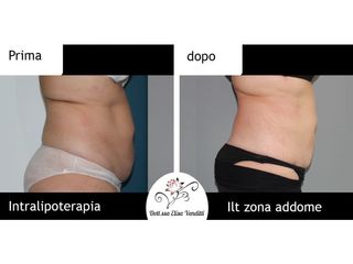Intralipoterapia prima e dopo