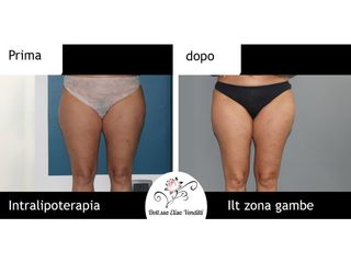 Intralipoterapia prima e dopo