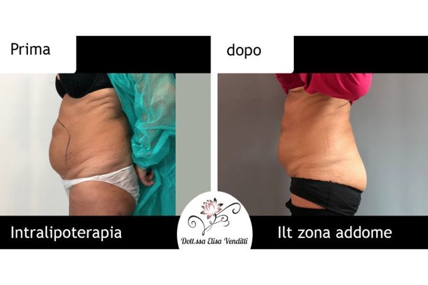 Intralipoterapia prima e dopo - 771180