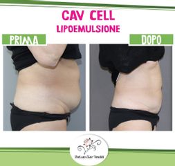 Liposuzione  - Dott.ssa Elisa Venditti