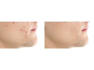 Trattamento Acne prima dopo