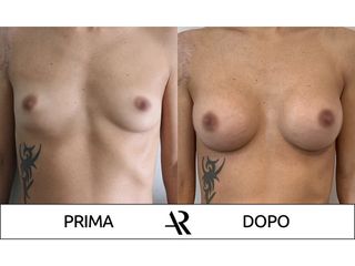 Mastoplastica additiva - Dott. Antonio Russo A.R.