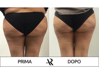 Liposuzione - Dott. Antonio Russo A.R.