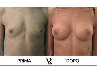 Mastoplastica additiva - Dott. Antonio Russo A.R.