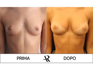 Mastoplastica additiva - Dott. Antonio Russo A.R.