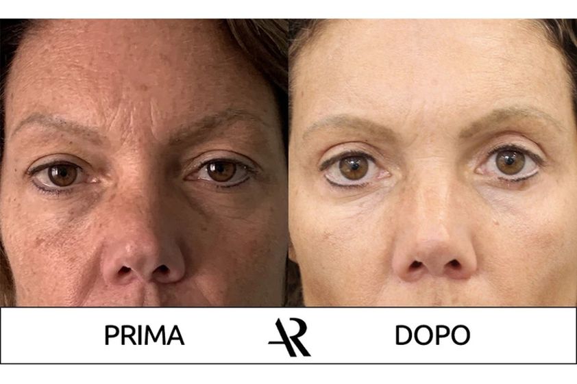 Eliminare occhiaie prima e dopo - 850748