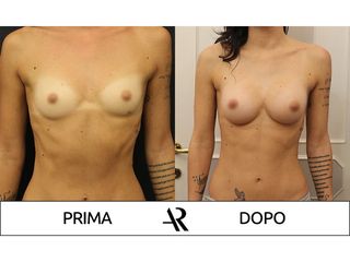 Mastoplastica additiva - Dott. Antonio Russo A.R.
