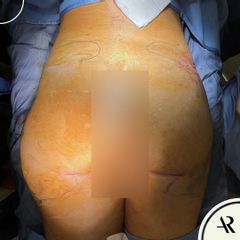 Gluteoplastica - Dott. Antonio Russo A.R.