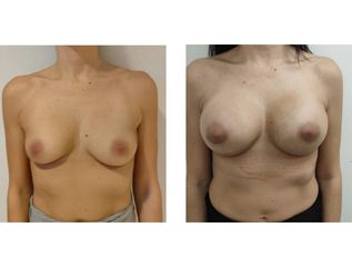 Mastoplastica additiva - Cristina Napoleone Chirurgo Plastico, Med. Estetica