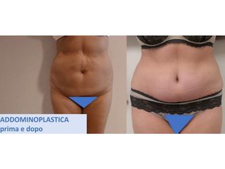 Addominoplastica - Cristina Napoleone Chirurgo Plastico, Med. Estetica