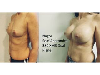 Mastoplastica additiva - Cristina Napoleone Chirurgo Plastico, Med. Estetica