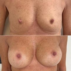 Mastoplastica additiva - Dott.ssa Cristina Napoleone