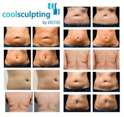 Coolsculpting prima dopo
