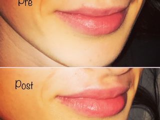 Filler labbra prima e dopo