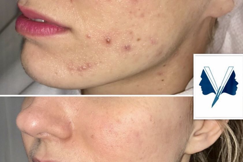 Acne prima e dopo - 763457