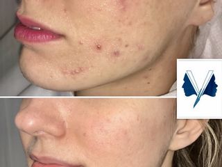 Cicatrici da acne prima e dopo