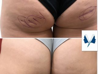 Cellulite prima e dopo