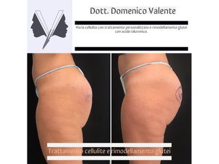 Cellulite prima e dopo