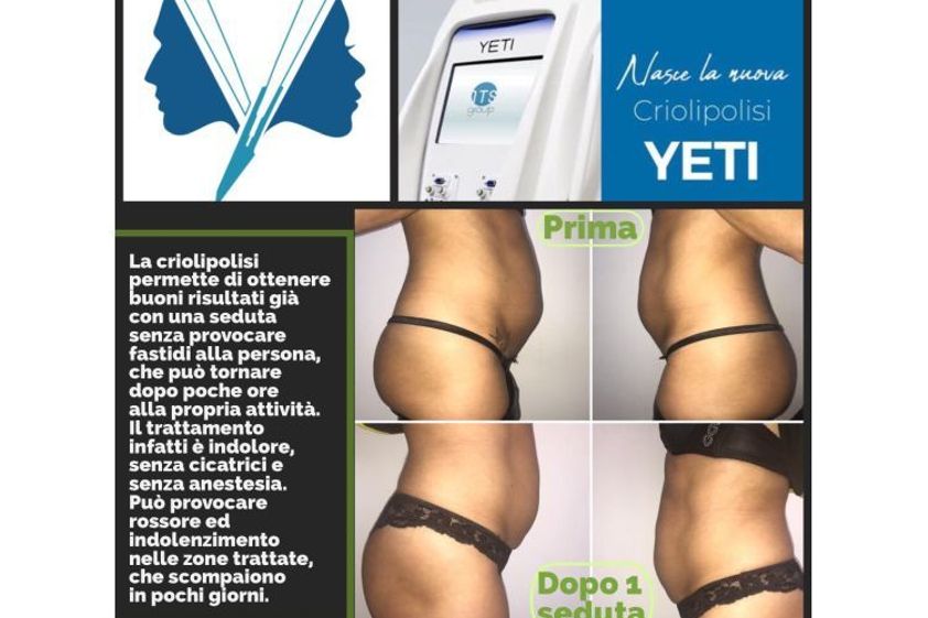 Criolipolisi prima e dopo - 769839