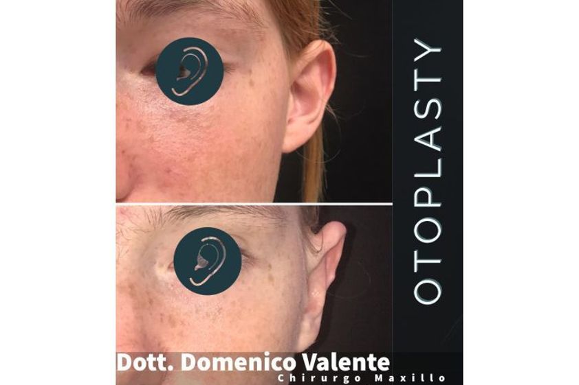 Otoplastica prima e dopo - 769843