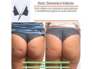 Cellulite prima e dopo