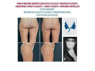 Liposuzione - Dott. Domenico Valente