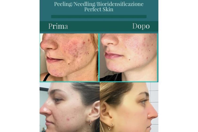 Peeling chimico prima e dopo - 773137