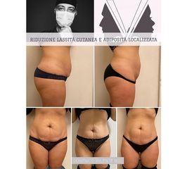 Liposuzione - Dott. Domenico Valente