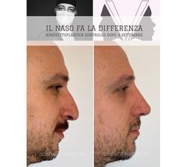 Rinoplastica - Dott. Domenico Valente