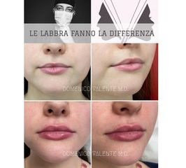 Filler labbra - Dott. Domenico Valente