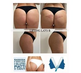 Gluteoplastica - Dott. Domenico Valente