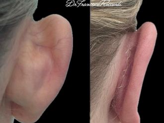 Otoplastica prima e dopo - 878856
