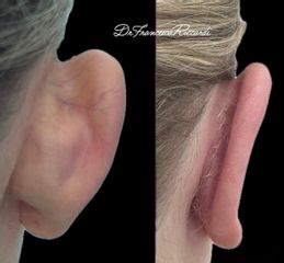 Clynic Como Otoplastica