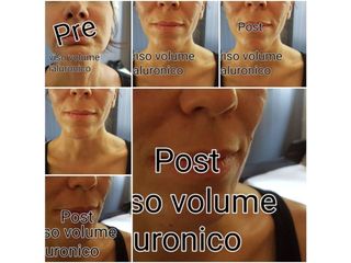 Lifting viso prima e dopo