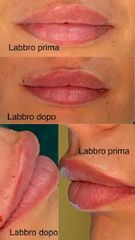 Filler labbra - Dott. Maurizio Santoro