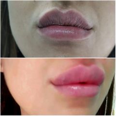 Filler labbra (Russian Lips) - Dott. Maurizio Santoro