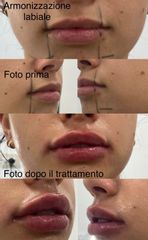 Filler labbra  - Dott. Maurizio Santoro