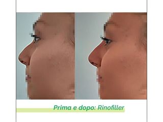 Rinofiller - Dott.ssa Eliana Lanza