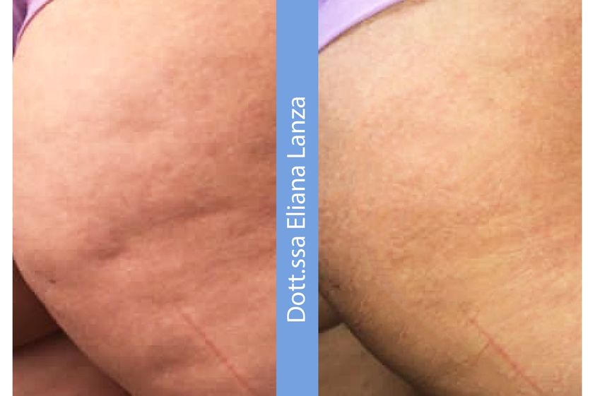 Cellulite prima e dopo - 790897