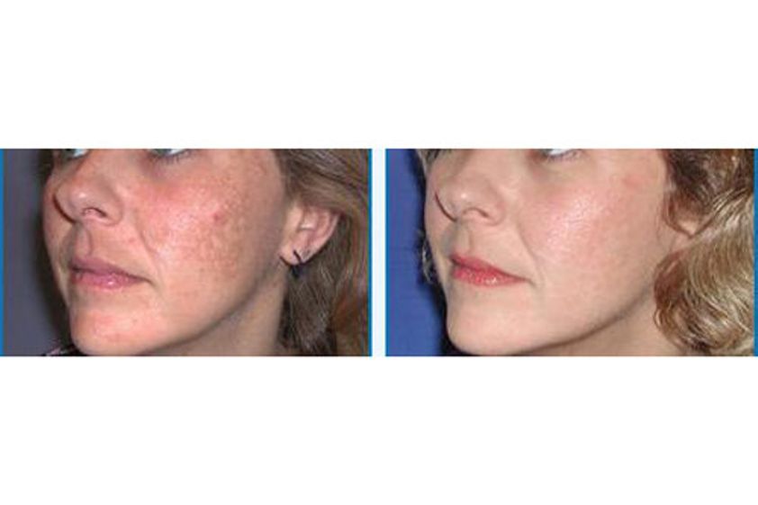 Needling prima e dopo - 743946