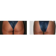 Liposuzione prima e dopo