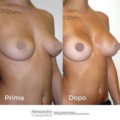 Mastoplastica additiva - Dott. Alessandro Covacivich
