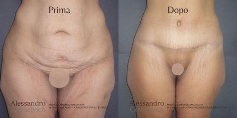 Addominoplastica - Dott. Alessandro Covacivich