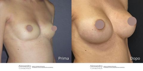 Mastoplastica additiva - Dott. Alessandro Covacivich