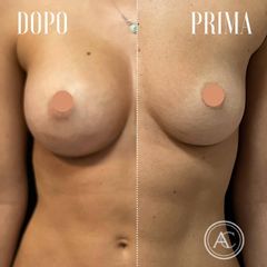 Mastoplastica additiva - Dott. Alessandro Covacivich