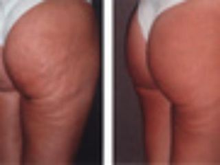 Cellulite prima dopo